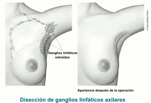 disecciondeganglios